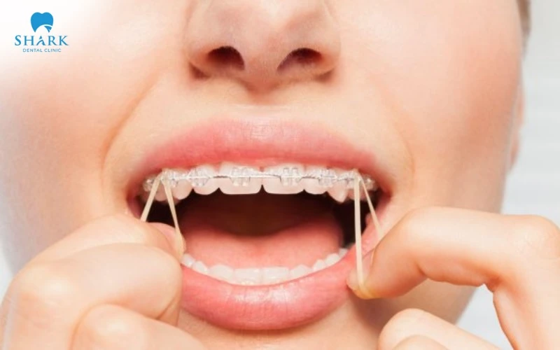 Nghịch dây thun niềng răng sẽ dễ dẫn đến tình trạng nuốt chúng