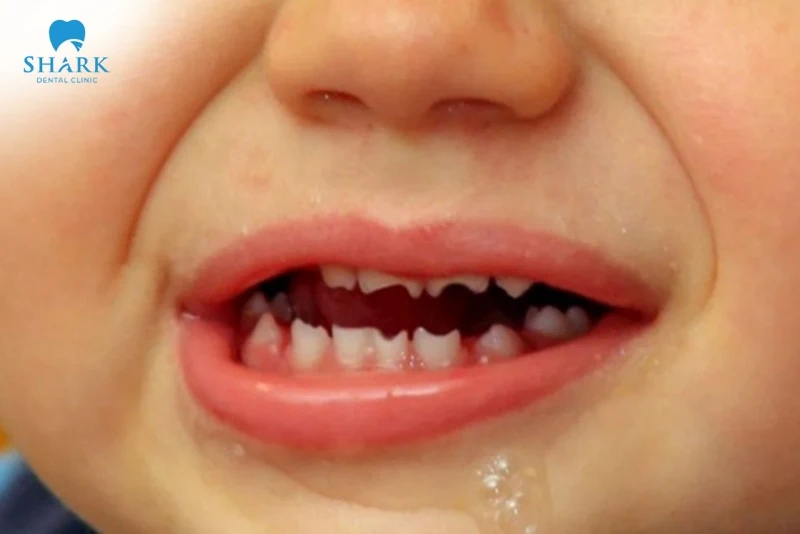 Cấu trúc rìa cắn có vết lõm hình chữ V