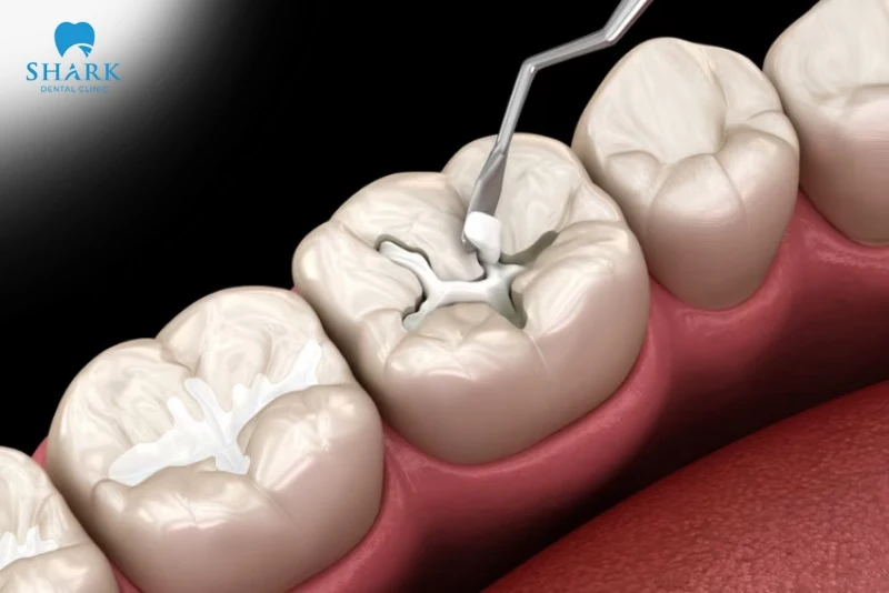 Trám răng thẩm mỹ