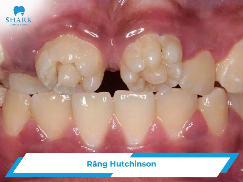 Răng Hutchinson