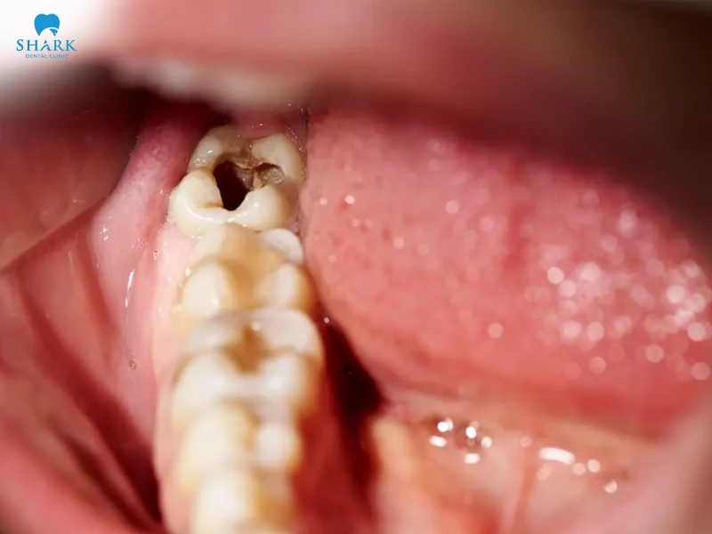 răng khôn bị sâu