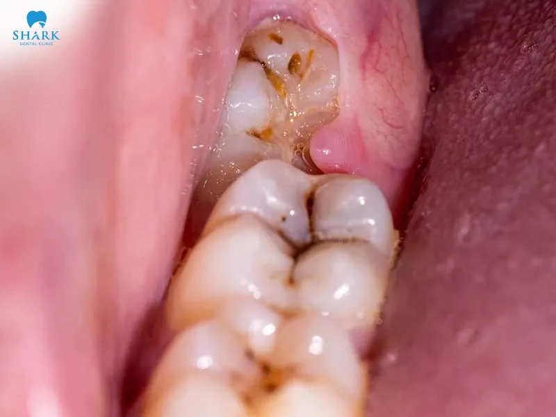 nhổ răng khôn bị sâu