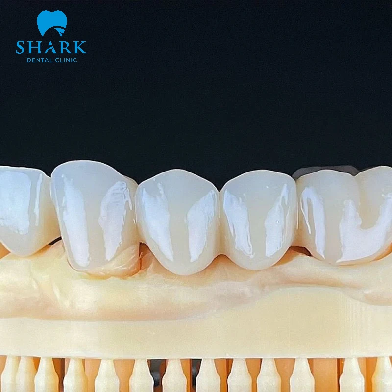 Răng Roland có độ cứng cao vì thế cần cân nhắc vị trí phục hình được chính xác từng li để tránh ảnh hưởng đến răng kế cận