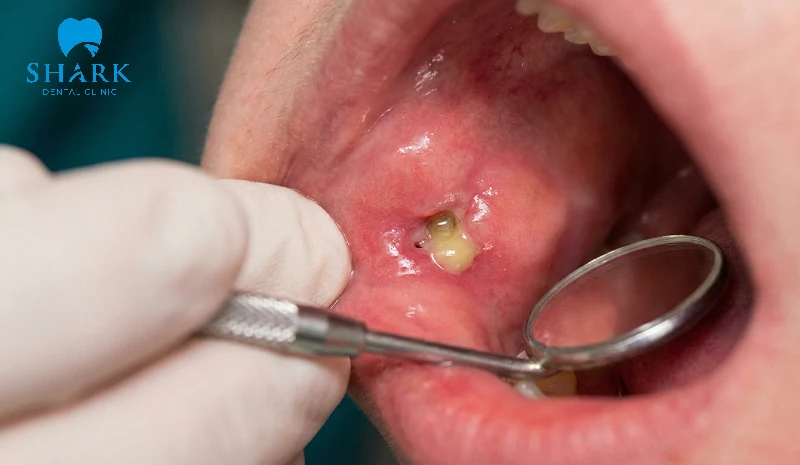 Lỗ rò mủ mạn tính trên niêm mạc