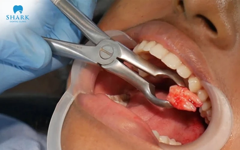 Nhổ răng khôn xong bạn nên ngậm bông gòn ít nhất 2-3 tiếng và nuốt luôn máu răng