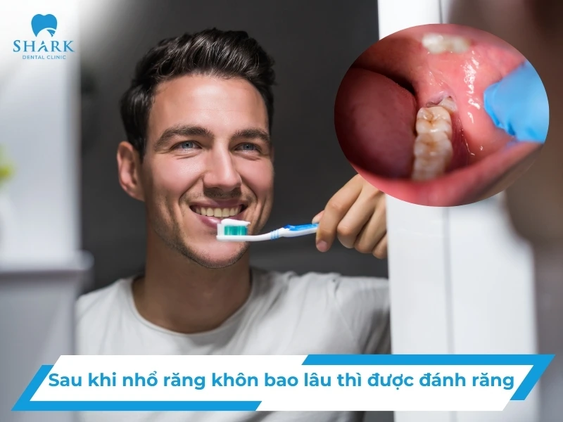 Sau khi nhổ răng khôn bao lâu thì được đánh răng? 12 Sau khi nhổ răng khôn bao lâu thì được đánh răng