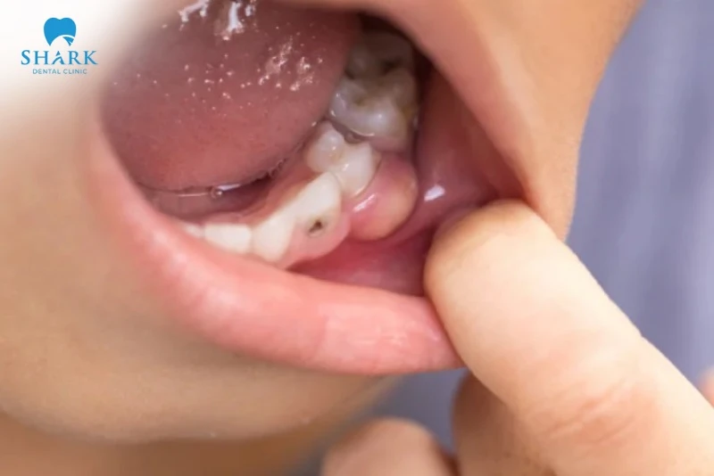 Sưng mộng răng là gì? Nguyên nhân và cách điều trị an toàn 8 Sưng mộng răng