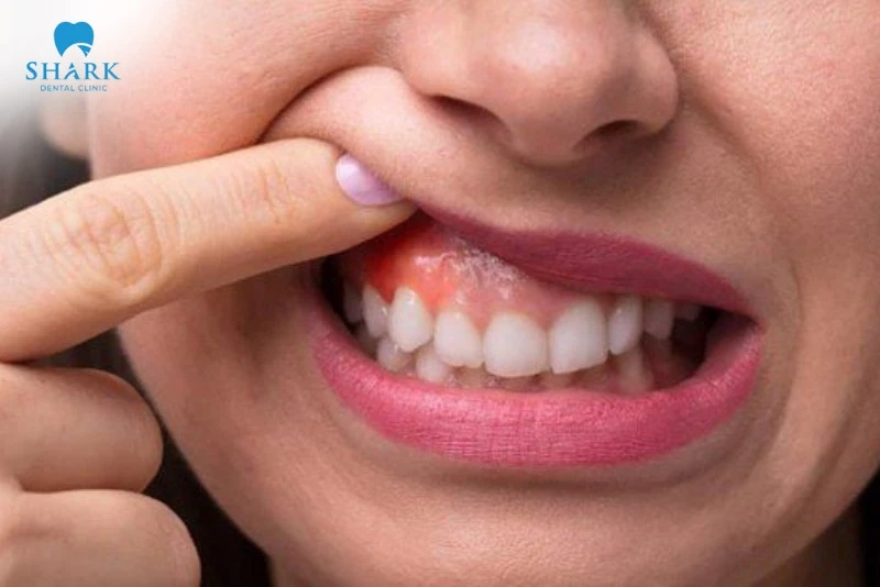 Sưng mộng răng là gì? Nguyên nhân và cách điều trị an toàn 9 Nướu đổi màu và sưng phồng kèm cảm giác đau nhức là dấu hiệu sưng mộng răng