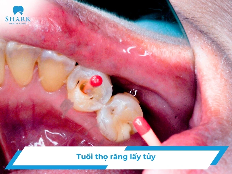 Tuổi thọ răng lấy tủy? Răng đã lấy tủy có tồn tại hết đời không? 8 Tuổi thọ răng lấy tủy