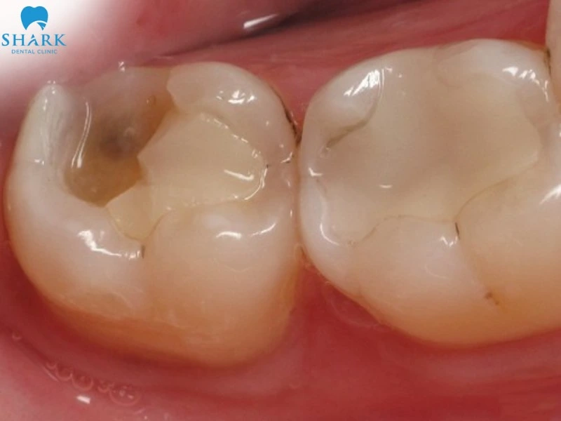 Nếu chăm sóc răng tốt sau khi đã lấy tủy kết hợp cùng phương pháp bọc sứ thì có thể tồn tại vĩnh viễn