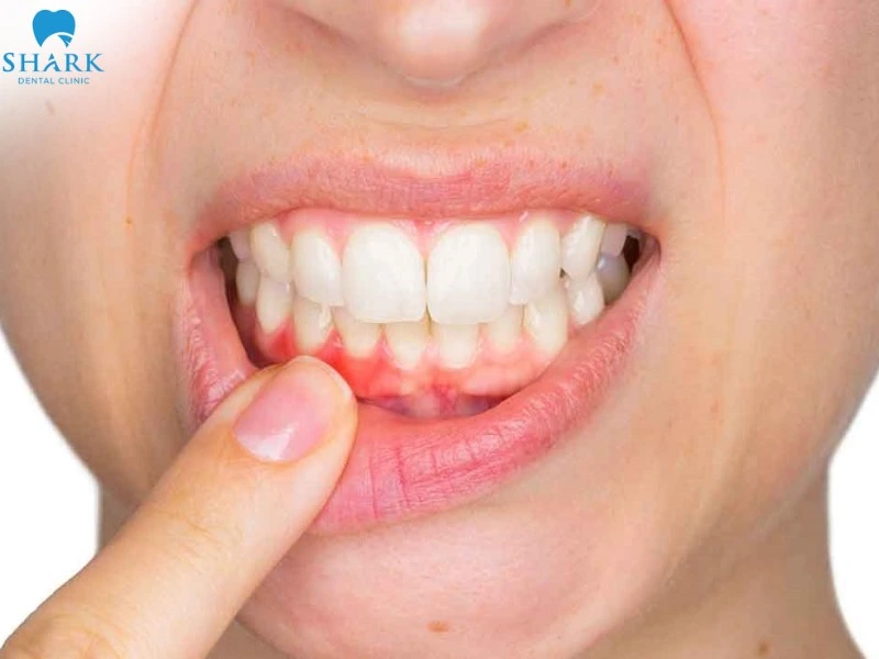 Răng đã loại bỏ tủy nếu không chăm sóc kỹ dễ tái phát bệnh lý viêm nhiễm