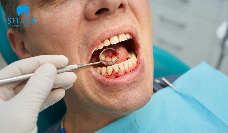 Viêm cuống răng cấp tính