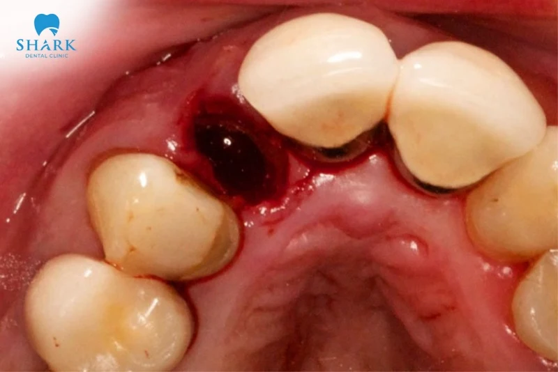 Viêm huyệt ổ răng khô