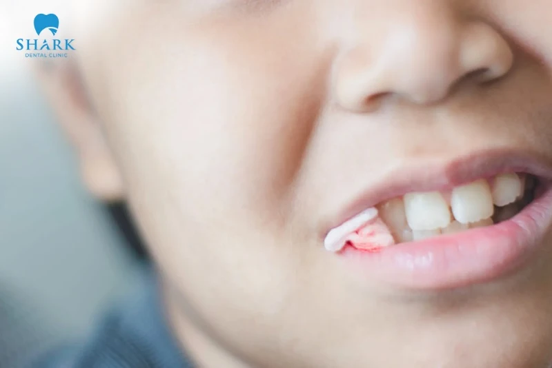 Cắn bông sau khi nhổ răng đúng thời gian quy định để tránh viêm ổ răng