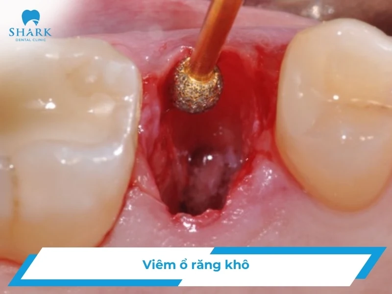 Viêm ổ răng khô