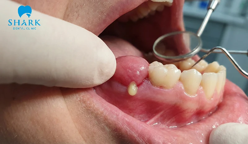 Vùng nướu tương ứng chóp răng sưng đỏ, ấn vào có mủ chảy ra