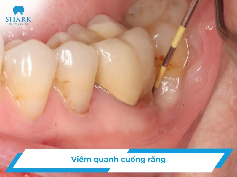 Viêm quanh cuống răng