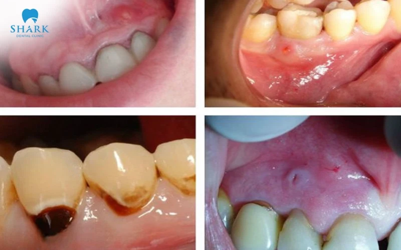 Viêm cuống răng mạn tính