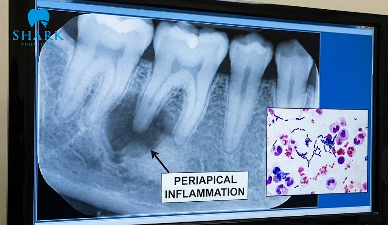 Viêm cuống răng do nhiễm khuẩn
