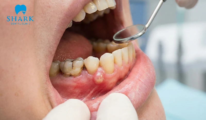 Viêm quanh cuống răng do chấn thương