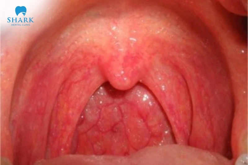 Amidan bình thường hồng hào