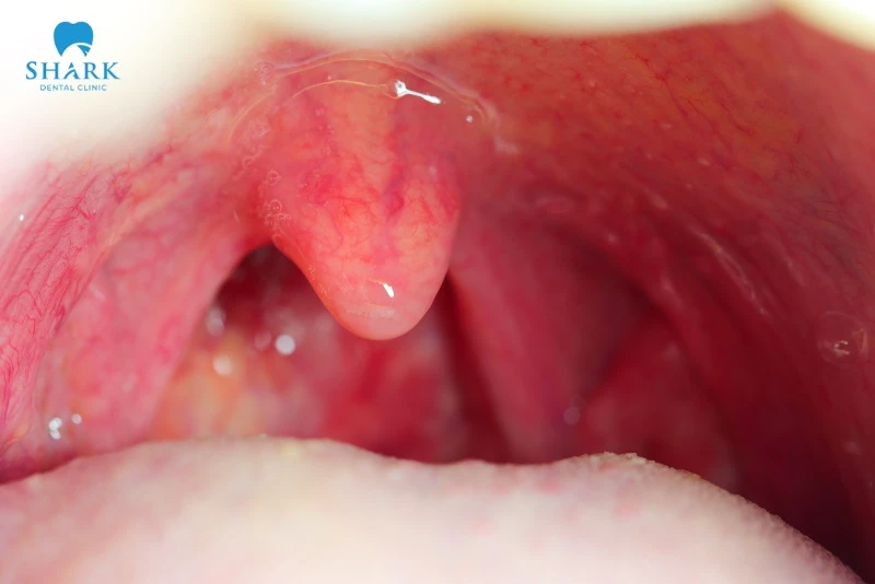 Màn hầu bình thường