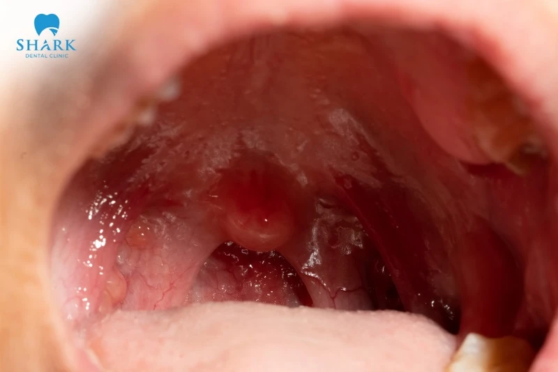 Niêm mạc bình thường không bị xung huyết