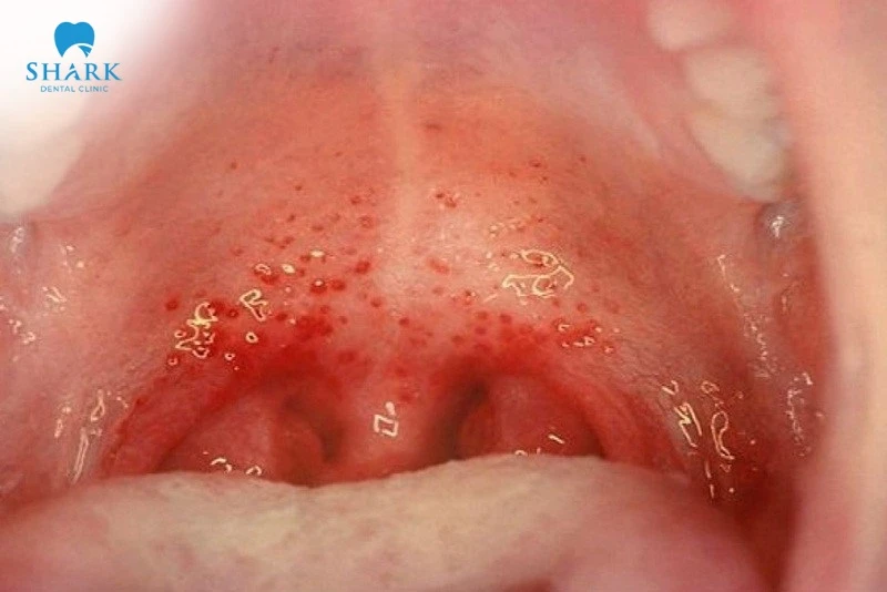 Niêm mạc bị viêm và nổi hạt