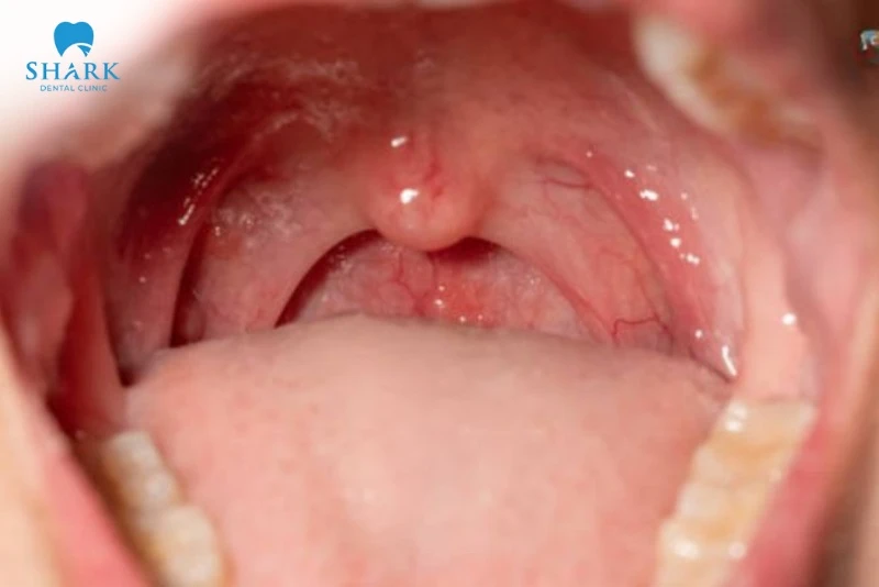 Vòm họng bình thường không có triệu chứng sưng tấy