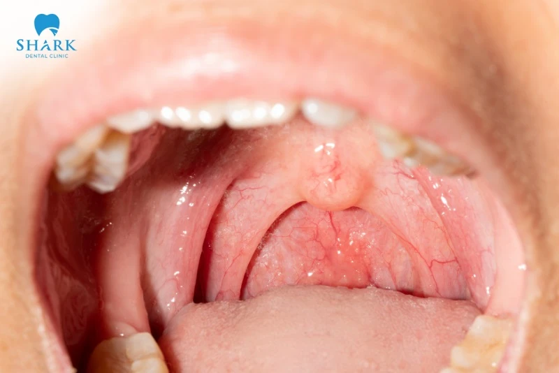 Họng bình thường không sưng và đủ độ ẩm