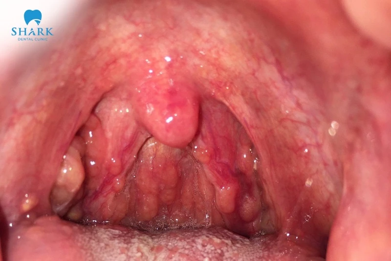 Amidan sưng to gây khó chịu và đau họng