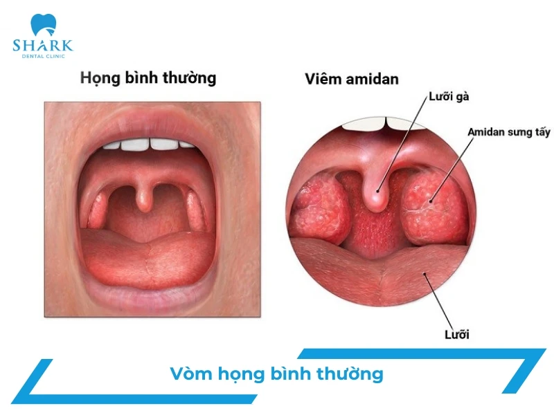 Vòm họng bình thường