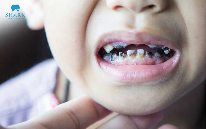 Răng xuất hiện những lỗ sâu to ở giai đoạn 2 của xiết ăn răng