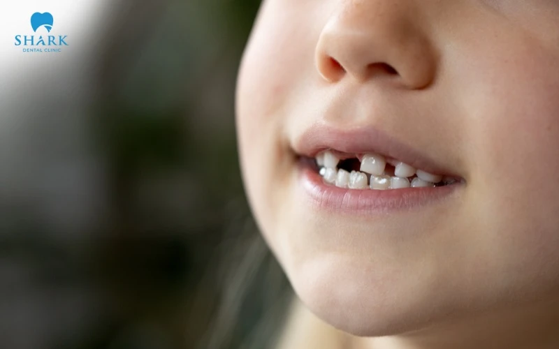 Răng có thể bị thối tủy khi không điều trị xiết ăn răng sớm