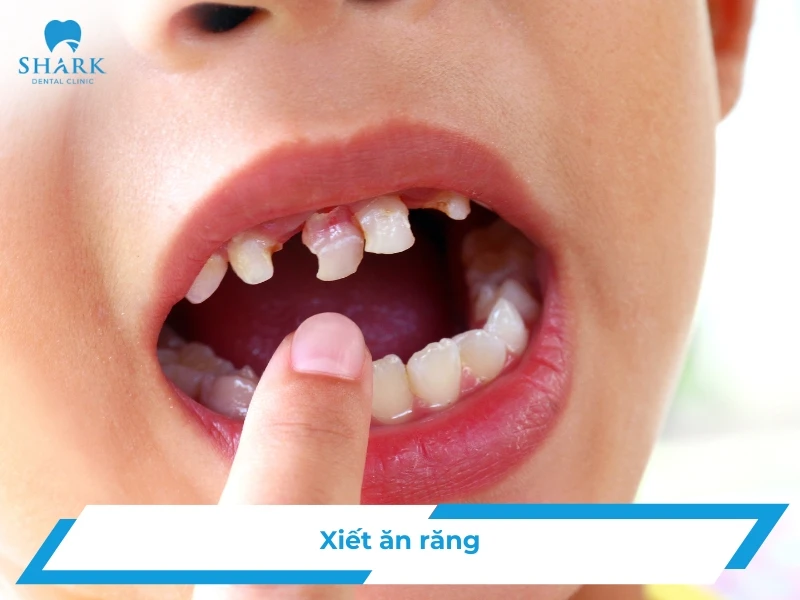 Xiết ăn răng