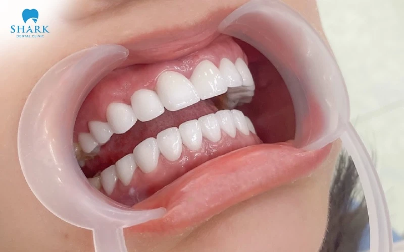 Bọc sứ cho trẻ khi chưa đủ tuổi sẽ gây ra nhiều rủi ro cho sức khỏe răng miệng