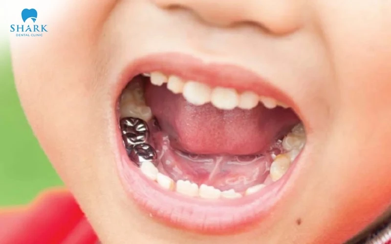 Bọc mão thép cho trẻ