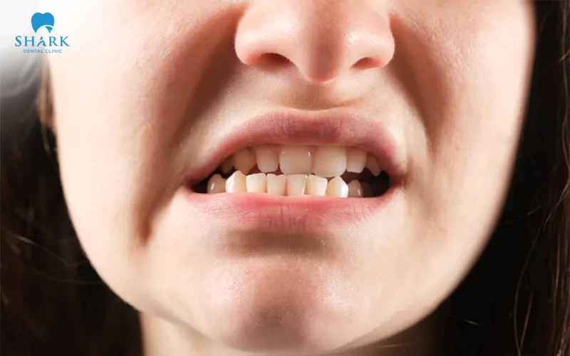 Các loại khớp cắn trong chỉnh nha thường gặp và cách điều trị 25 Hình ảnh người bị khớp cắn chéo