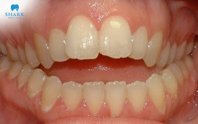 Các loại khớp cắn trong chỉnh nha thường gặp và cách điều trị 26 Khớp cắn hở