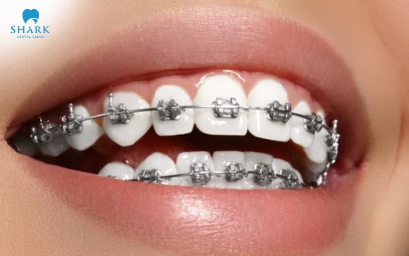 Các loại khớp cắn trong chỉnh nha thường gặp và cách điều trị 28 Niềng răng mắc cài kim loại