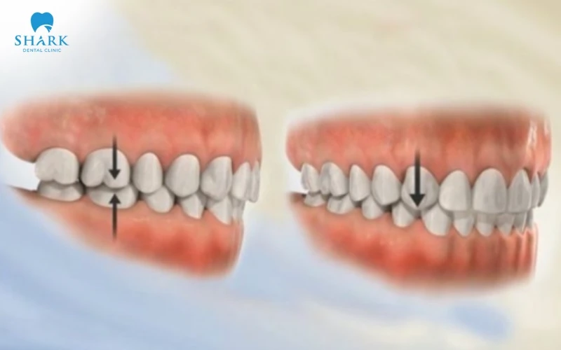 Các loại khớp cắn trong chỉnh nha thường gặp và cách điều trị 18 Khớp cắn loại 1