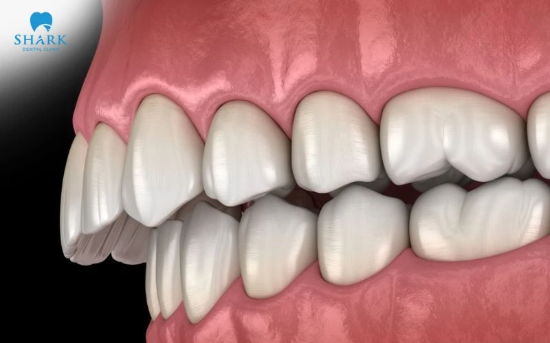 Các loại khớp cắn trong chỉnh nha thường gặp và cách điều trị 19 Khớp cắn loại 2