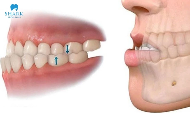 Các loại khớp cắn trong chỉnh nha thường gặp và cách điều trị 20 Khớp cắn loại 3