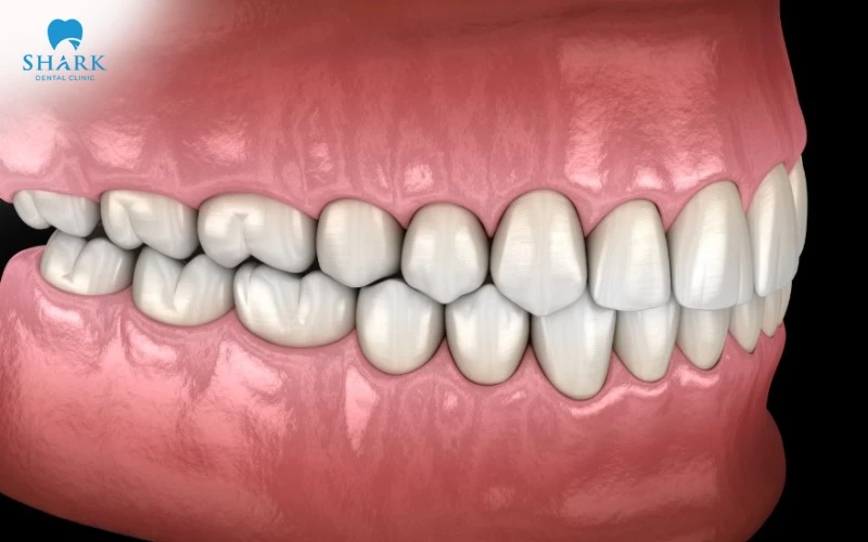 Các loại khớp cắn trong chỉnh nha thường gặp và cách điều trị 21 Khớp cắn chuẩn