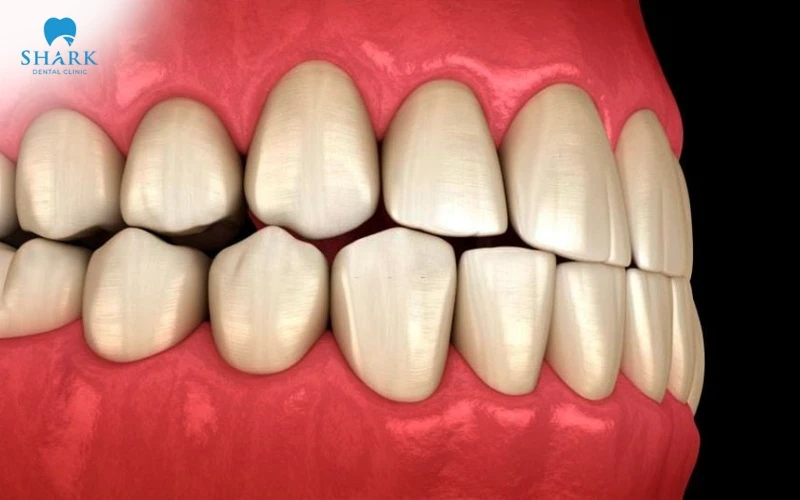 Các loại khớp cắn trong chỉnh nha thường gặp và cách điều trị 23 Hình ảnh khớp cắn đối đầu