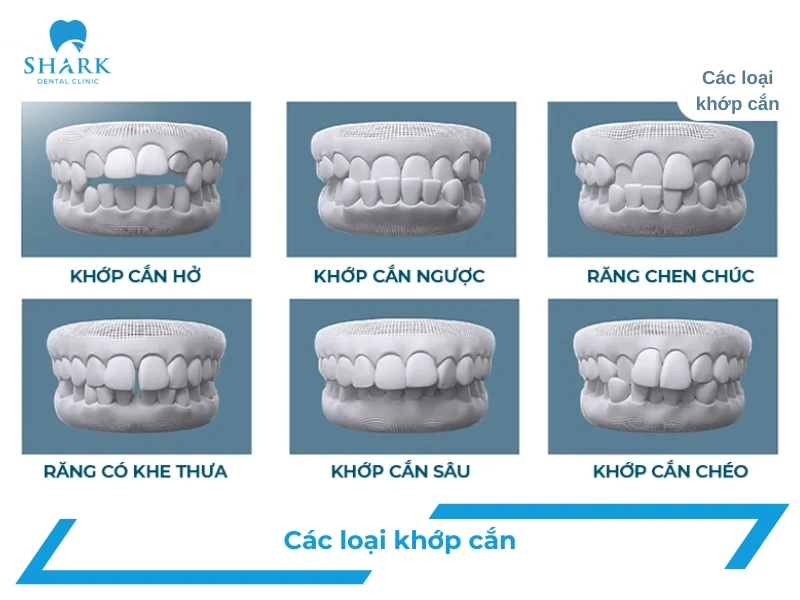 Các loại khớp cắn trong chỉnh nha