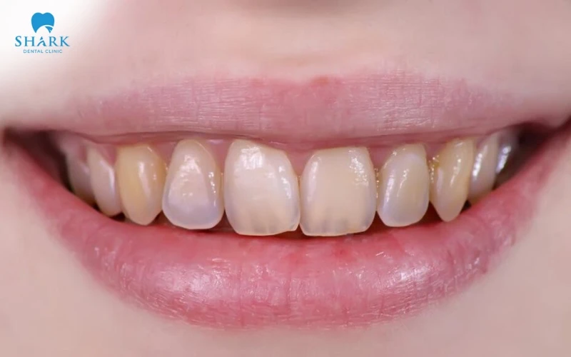 Vỏ chuối chỉ phù hợp với người có răng xỉn màu nhẹ