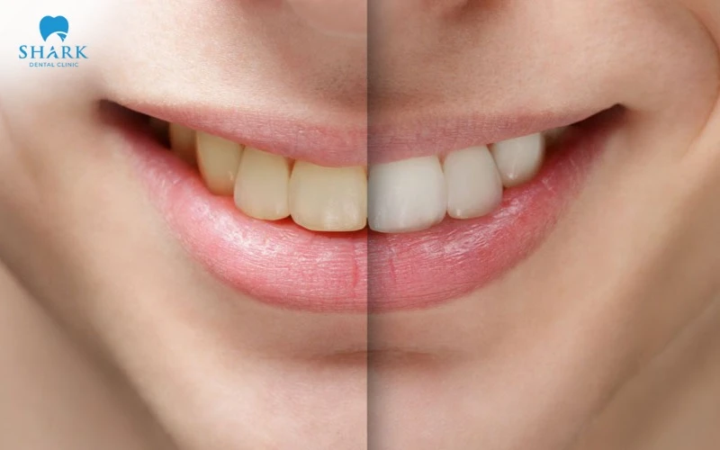 Tông màu răng sẽ không sáng rõ rệt như phương pháp tẩy trắng răng bằng công nghệ