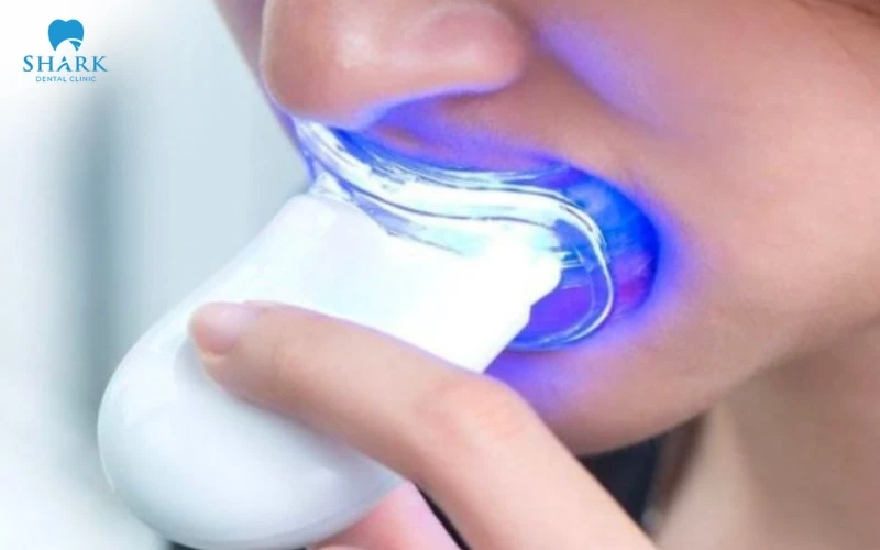 2 cách làm trắng răng với bánh mì hiệu quả và an toàn tại nhà 14 Sử dụng máng làm trắng răng ngay tại nhà