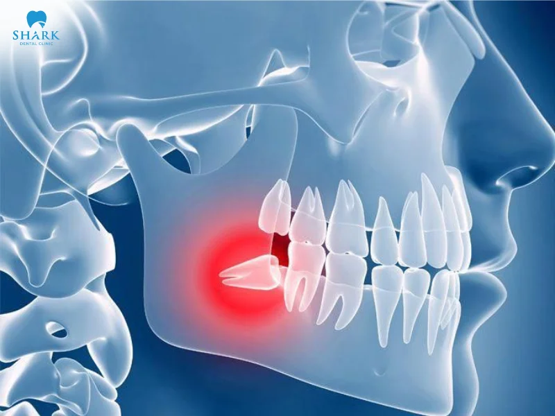 Có nên nhổ răng khôn khi đang bị đau không? 9 Răng khôn mọc lệch đâm vào răng bên cạnh dễ gây đau kéo dài, viêm nhiễm và thường được chỉ định nhổ sớm để tránh biến chứng